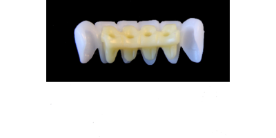 Ref.E12+E12 f Lower Anterior :  1x  white wax veneer-bridge, (33-43), carved to fit over its compatible yellow hollow pontic block-frame, (32-42) , both SMALL, for porcelain pressed to metal bridgework