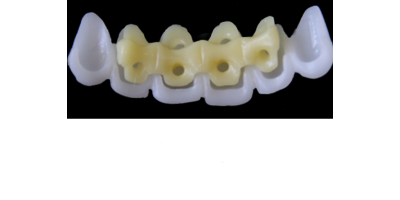 Ref.E1+E1 f Upper Anterior :  1x  white wax veneer-bridge, (23-13), carved to fit over its compatible yellow hollow pontic block-frame, (22-12) , both LARGE, Tapering ovoid,  for porcelain pressed to metal bridgework