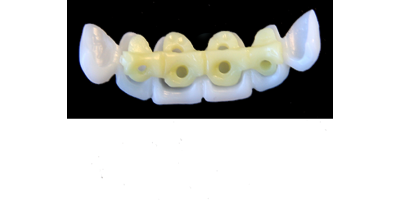Ref.E4+E4 f Upper Anterior :  1x  white wax veneer-bridge, (23-13), carved to fit over its compatible yellow hollow pontic block-frame, (22-12) , both MEDIUM, Triangular , for porcelain pressed to metal bridgework