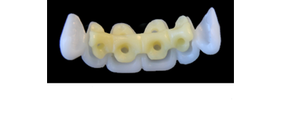 Ref.E5+E5 f Upper Anterior :  1x  white wax veneer-bridge, (23-13), carved to fit over its compatible yellow hollow pontic block-frame, (22-12) , both MEDIUM, Tapering ovoid , for porcelain pressed to metal bridgework