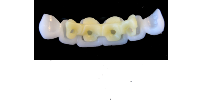 Ref.E6+E6 f Upper Anterior :  1x  white wax veneer-bridge, (23-13), carved to fit over its compatible yellow hollow pontic block-frame, (22-12) , both MEDIUM, Square ovoid,  for porcelain pressed to metal bridgework