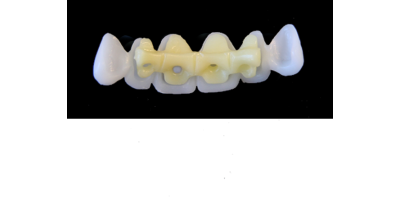 Ref.E8+E8 f Upper Anterior :  1x  white wax veneer-bridge, (23-13), carved to fit over its compatible yellow hollow pontic block-frame, (22-12) , both SMALL, Tapering ovoid , for porcelain pressed to metal bridgework
