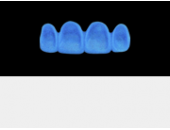 Cod.A18Lingual : 15x  wax lingual bridges,  MEDIUM, Square tapering, TOOTH 12-22, compatible with Cod.C18Facing,TOOTH 12-22, for long-term provisionals preparation