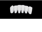 Cod.E14LOWER ANTERIOR: 10x  wax facings-bridges (hollow), MEDIUM, Overlapping, (43-33), compatible with solid (not  hollow) wax bridges Cod.S14LOWER ANTERIOR, (43-33)