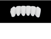 Cod.E15LOWER ANTERIOR: 10x  wax facings-bridges (hollow), SMALL, Overlapping, (43-33), compatible with solid (not  hollow) wax bridges Cod.S15LOWER ANTERIOR, (43-33)